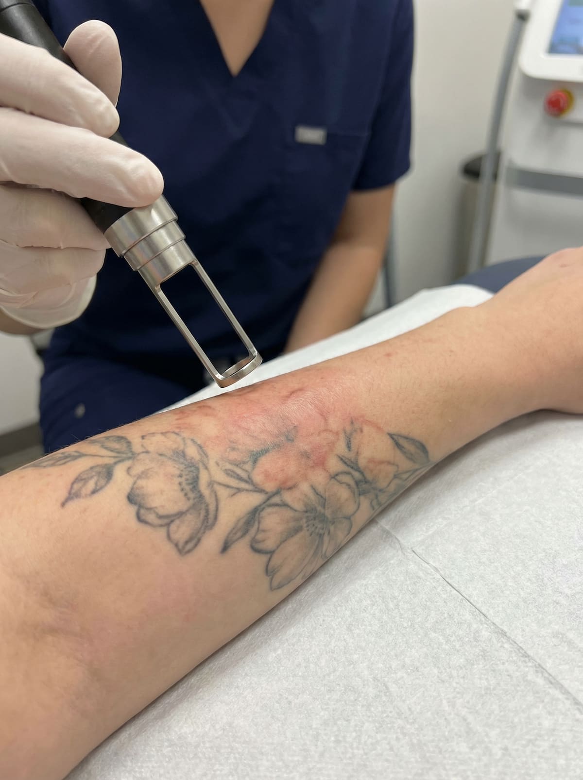 tattoo_removal-1