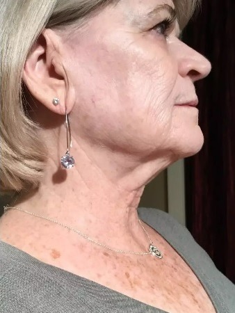 Before and after RF microneedling at Miracle Wellness — after
