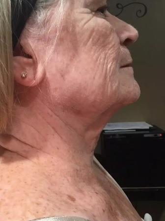 Before and after RF microneedling at Miracle Wellness — before