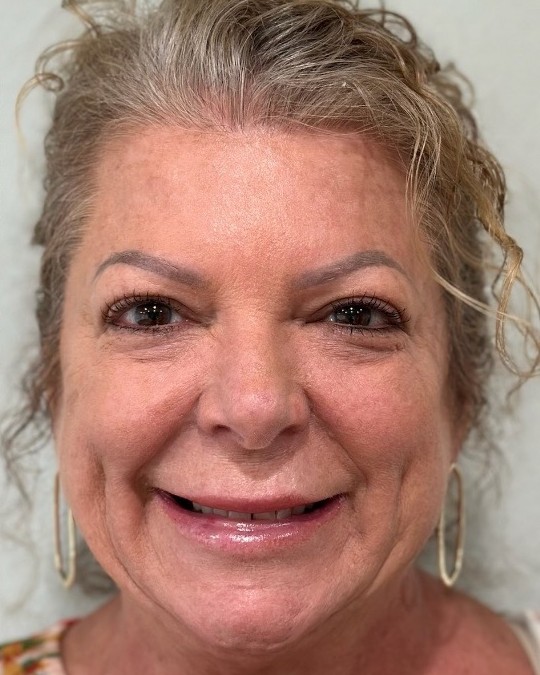 Before and after cheek contouring and tox at Miracle Wellness — after