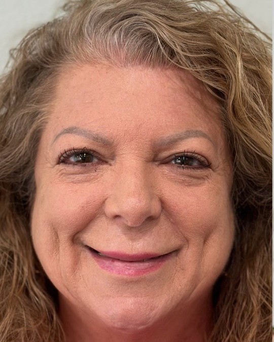 Before and after cheek contouring and tox at Miracle Wellness — before