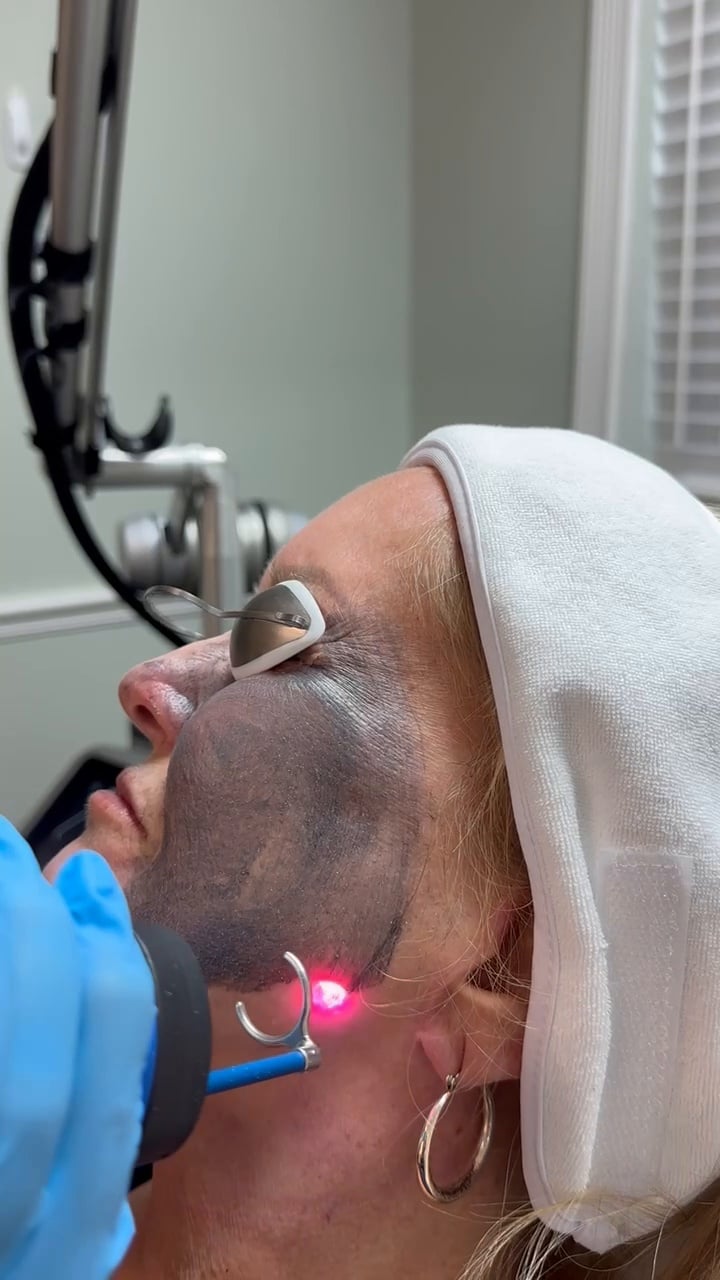 Hollywood Carbon Peel