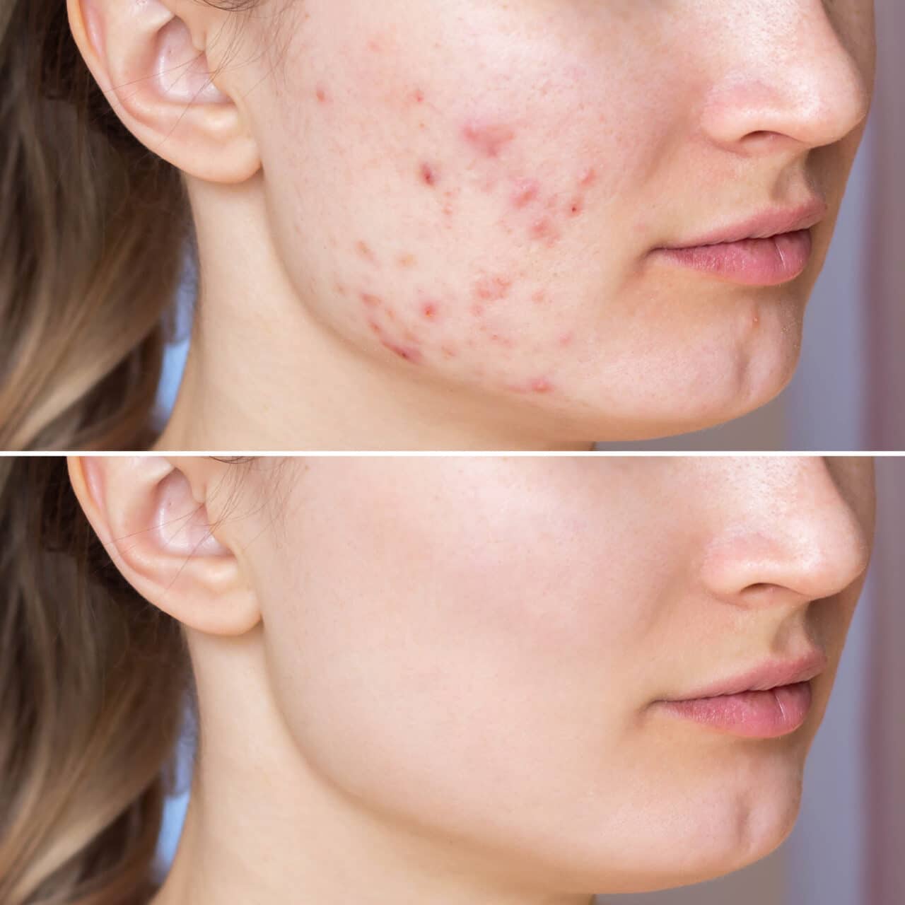 Cropped shot of a young woman's face before and after acne  trea