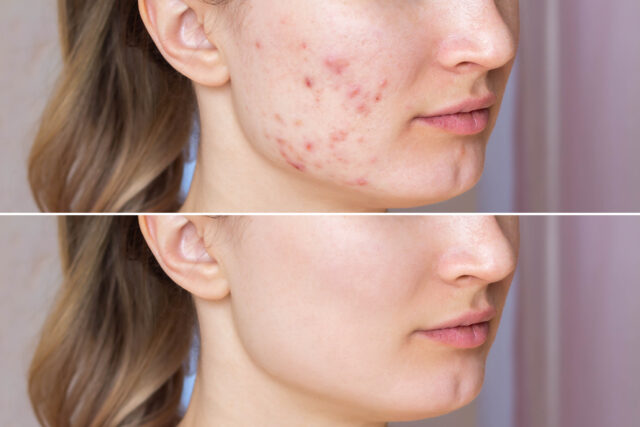 microneedling removes acne scars on young woman