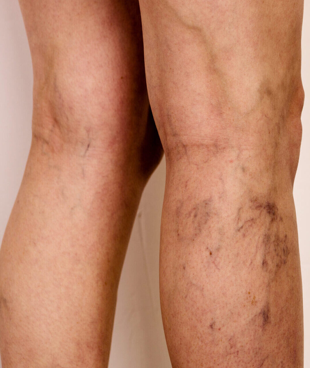 Varicose veins on a slim female legs. Phlebology - image