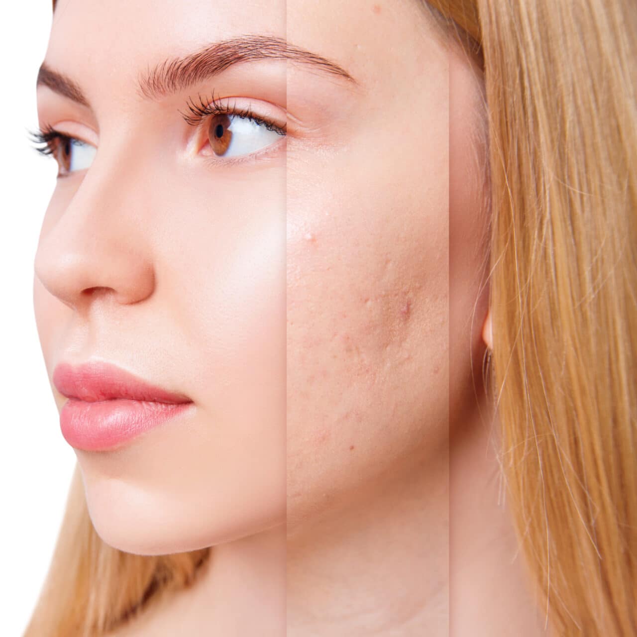 Face of beautiful woman before and after acne and postacne treatment. Beautician concept.