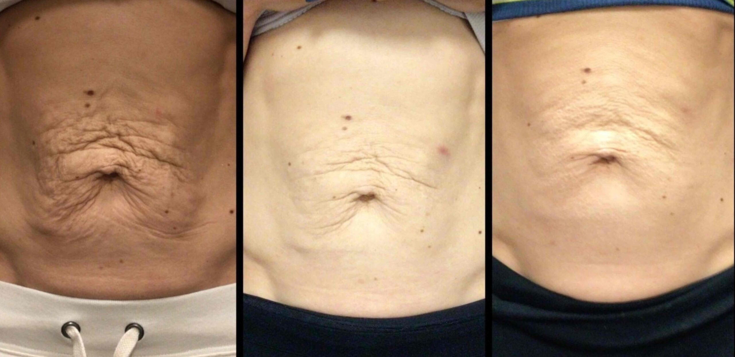microneedling stomach RF Microneedling stomach