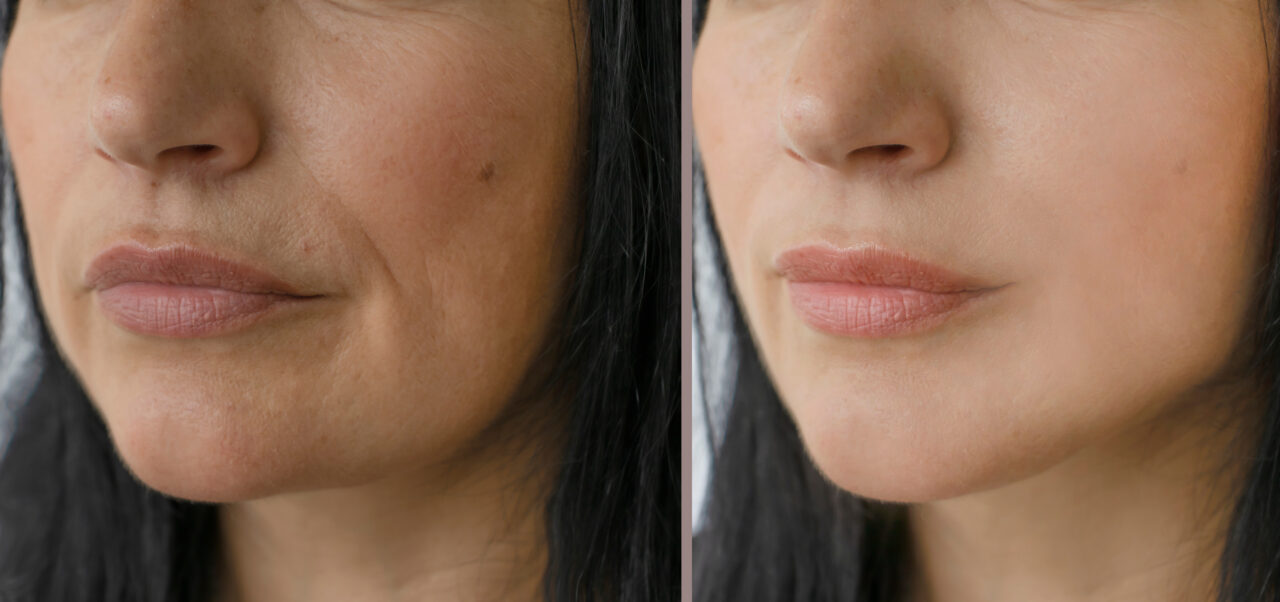 RF Microneedling: The Skin Transformation Treatment