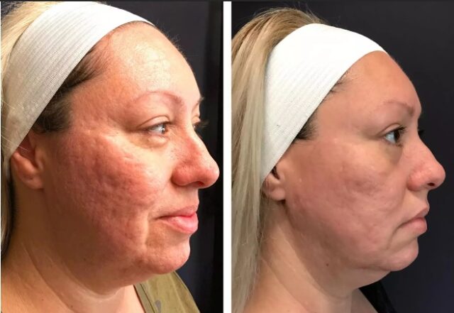 https://miraclewellness321.com/wp-content/uploads/2025/06/scarlet-acne-scars-640x441.jpg