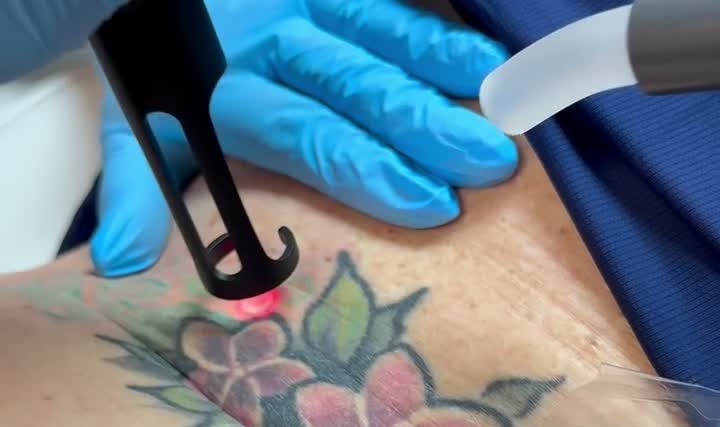 Thinking About Laser Tattoo Removal? Here’s What You Need to Know Before You Go